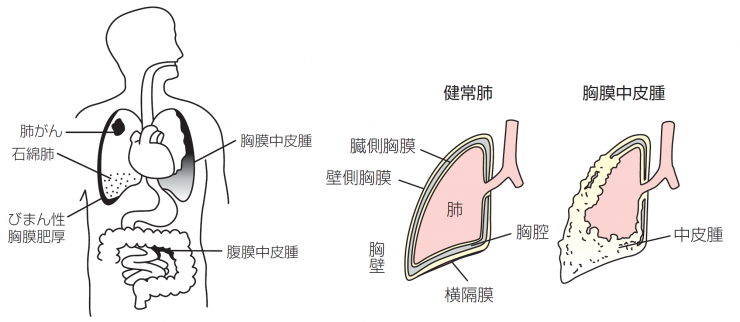 図1石綿が原因となって発症する主な疾患と部位